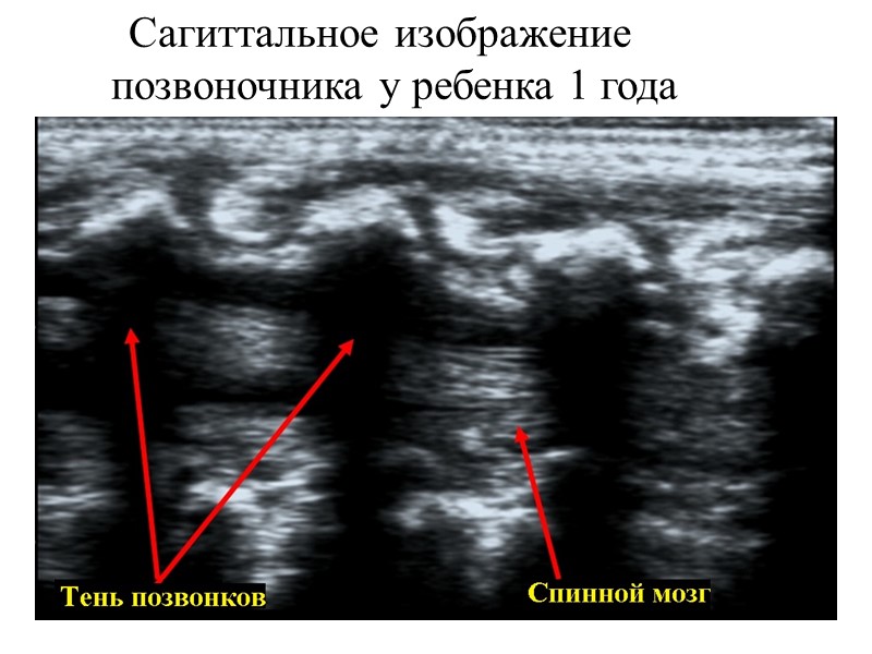 Сагиттальное изображение позвоночника у ребенка 1 года